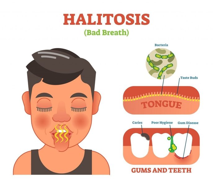 Visual representation of a tongue and its bacterial coating contributing to halitosis.