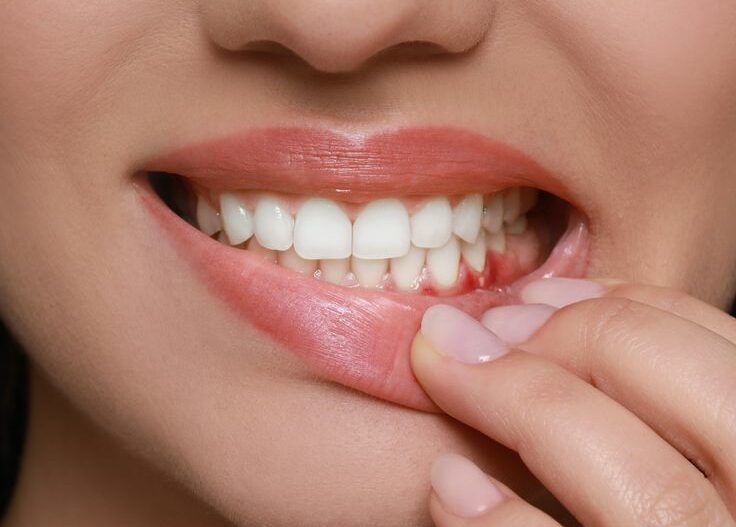 gum disease