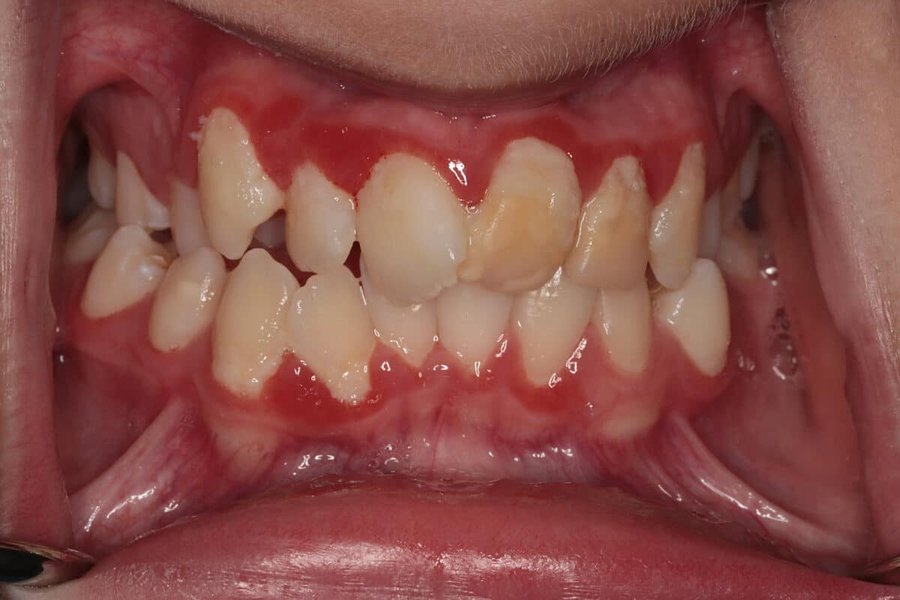 Inflamed gums appearing red and swollen are common symptoms of gingivitis.