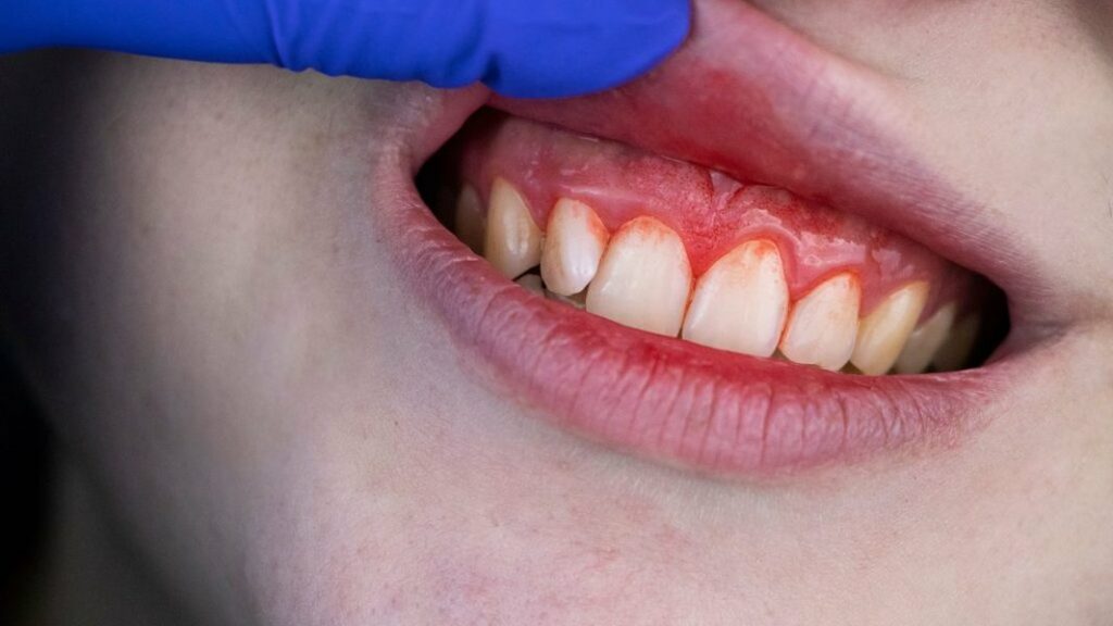 gum-disease-warning-signs-prevention