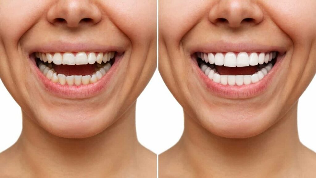 Real-world examples showcasing the transformative power of tooth whiteners.