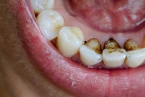 effects-smoking-on-teeth